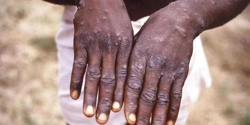 Monkeypox disease: ಮಂಕಿಪಾಕ್ಸ್ ರೋಗ ವ್ಯಕ್ತಿಯಲ್ಲಿ ಉಲ್ಬಣಿಸಲು 5 ರಿಂದ 13 ದಿನ ಬೇಕು: ಎಚ್ಚರಿಕೆ ವಹಿಸಲು ತಜ್ಞರ ಸಲಹೆ