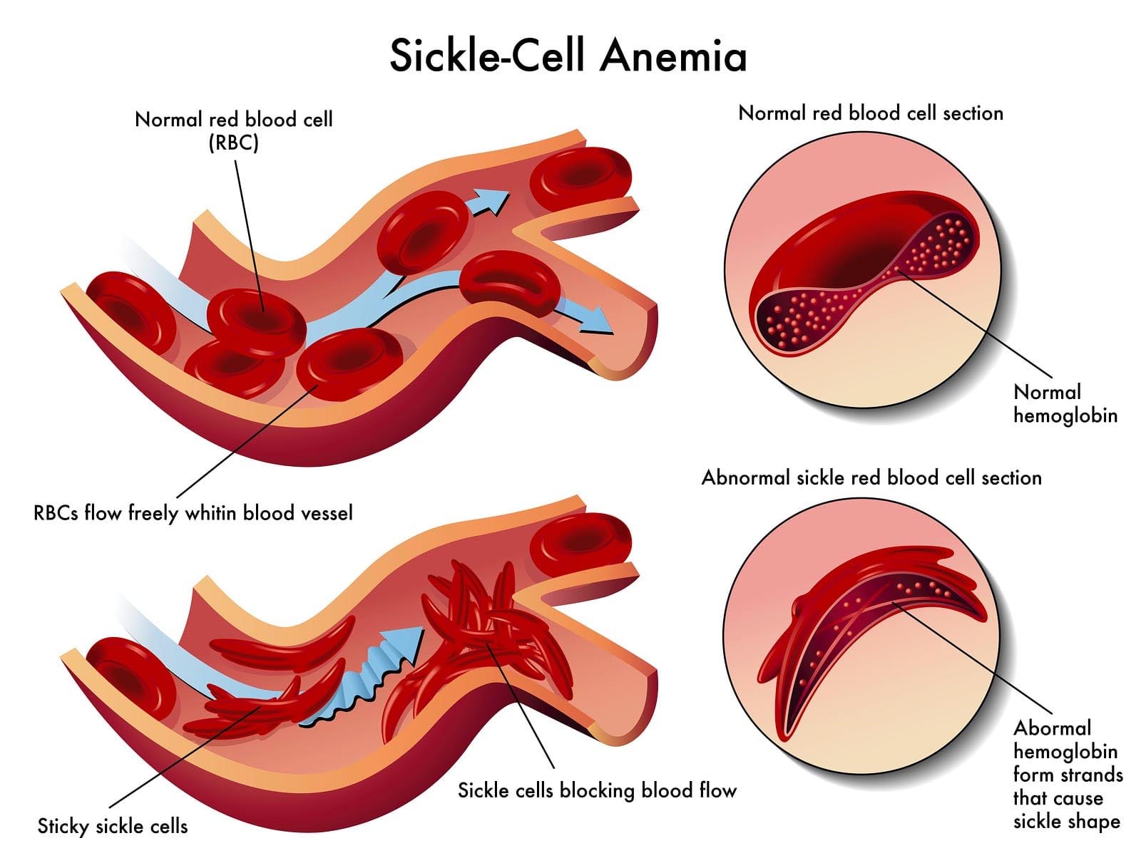 Anemia or anemia : ರಕ್ತಹೀನತೆ ಅಥವಾ ಅನೀಮಿಯಾ
