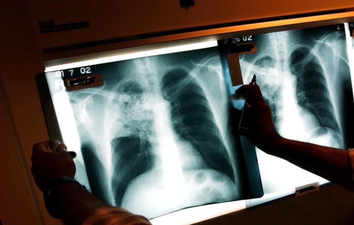 Rise in TB cases : ಕೋವಿಡ್-19 ಪರಿಣಾಮ ಮೊದಲ ಬಾರಿಗೆ ಟಿಬಿ ಪ್ರಕರಣ ಹೆಚ್ಚಳ